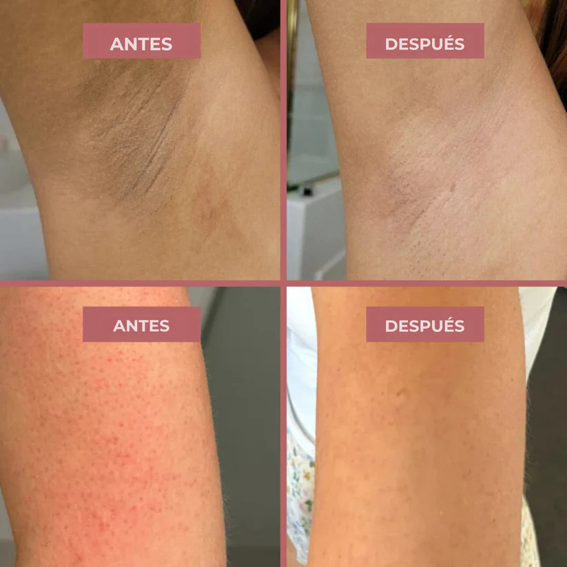 Kivana Peel Shot - Spray exfoliante corporal con ácido kójico y cúrcuma